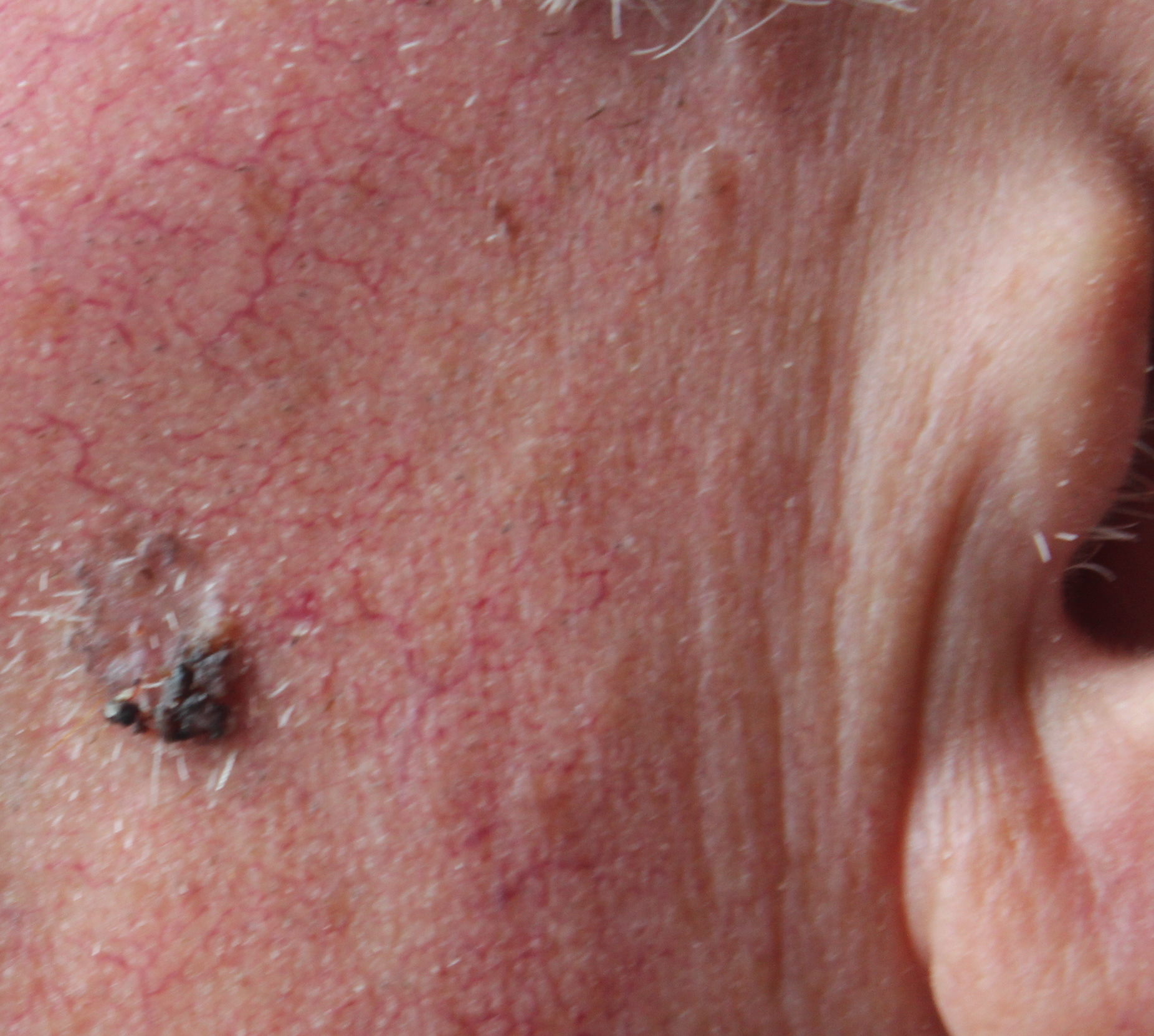 DMSO löscht Muttermal