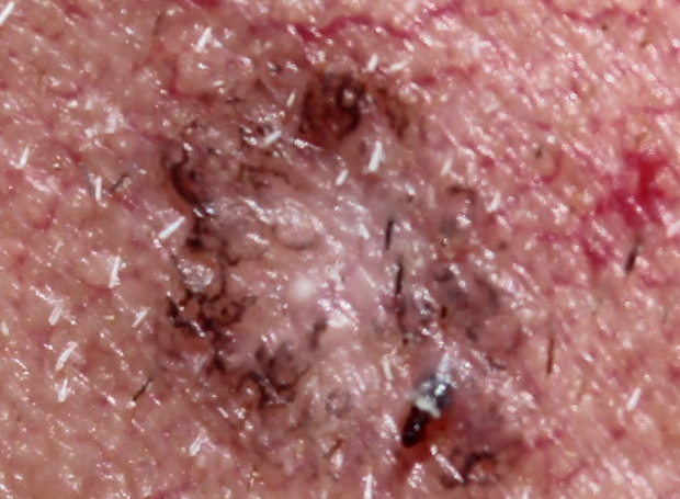 DMSO löscht Muttermal