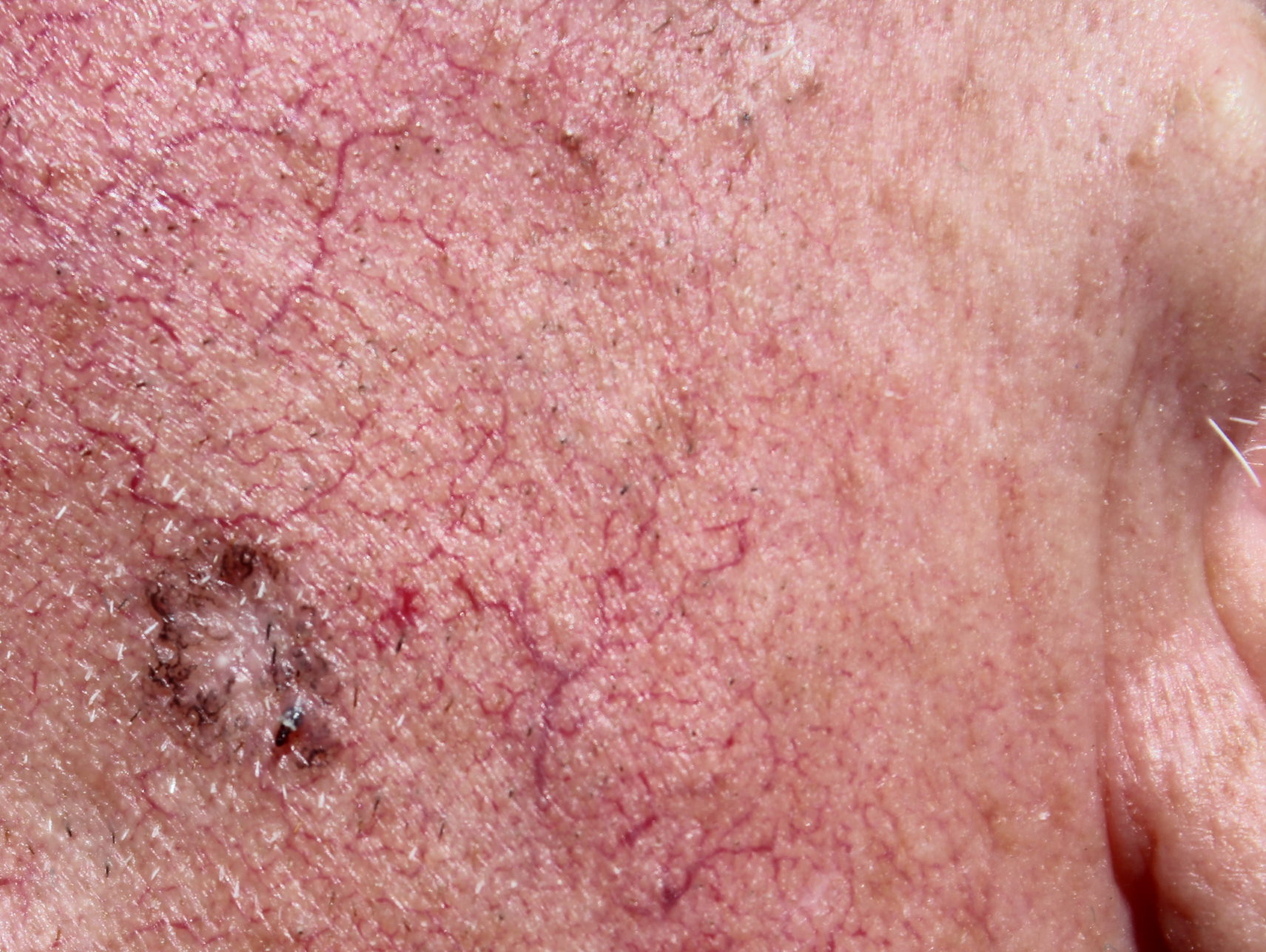 DMSO löscht Muttermal